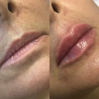 Увеличение губ