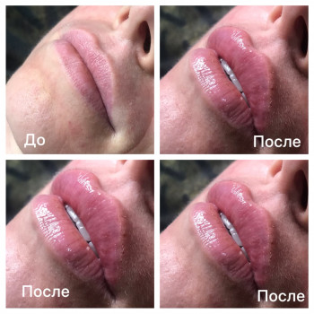 Увеличение губ