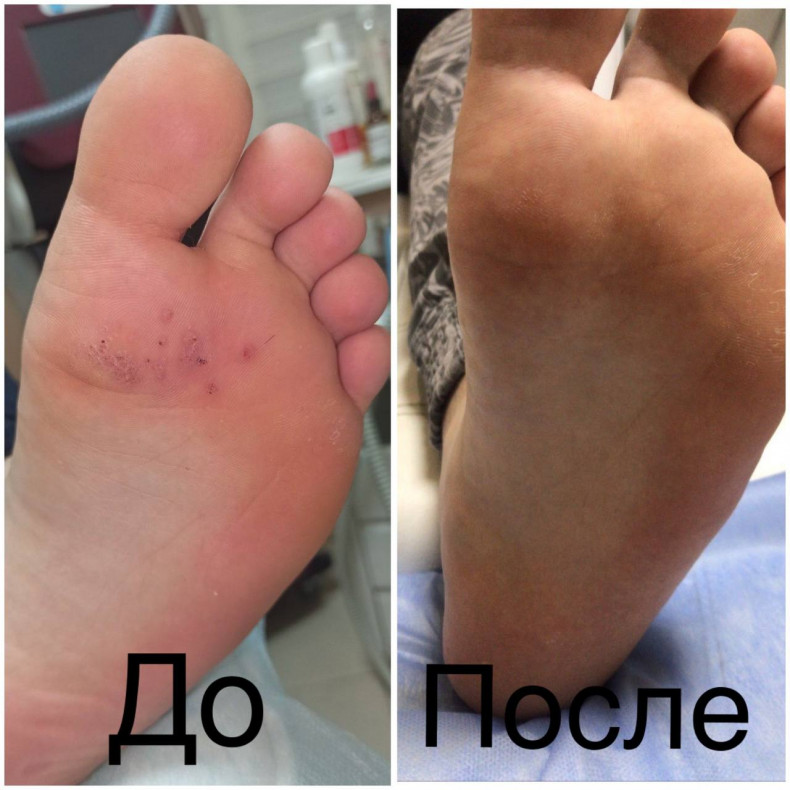Підошовні бородавки "До" та "Після", фото - Медицинский центр Лазерна Подологія