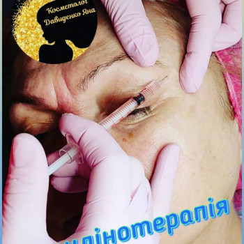 БОТУЛІНОТЕРАПІЯ