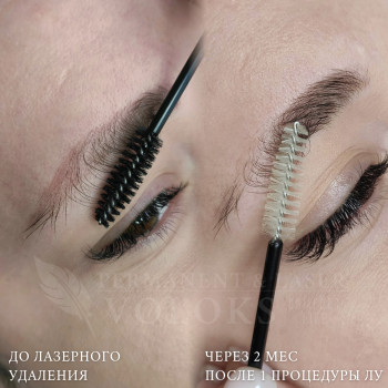 Удаление старого татуажа за 1 процедуру.