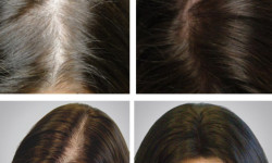 Мезотерапия кожи головы Косметолог-ін'єкціоніст Елена Київ