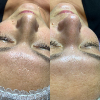 Механічна чистка