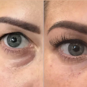 Коррекція нлосослізноі борозди