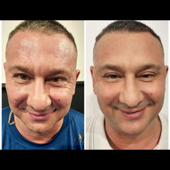 Ботулотоксин, полимолочная кислота.