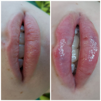 Увеличение губ.