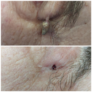 Удаление родиной, папилом.