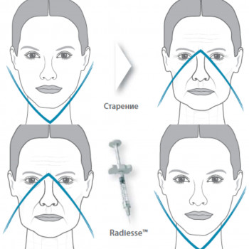 RADIESSE
                    Салон красоты NC Cosmetology Киев