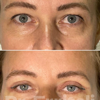 Блефаропластика круговая (верхних и нижних век)
                    Пластический хирург Абдель Харьков