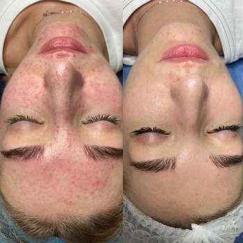 Чистка обличчя
                    Лікар-косметолог Катерина Івано-Франківськ