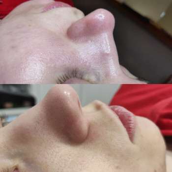 Чистка + пілінг по проблемі
                    Косметолог Людмила Киев