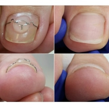 Скрученний ніготь
    
 
 
 
 
 