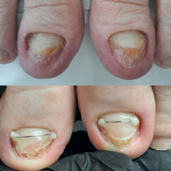 іСкрученний ніготь
    
 
 
 
 
 