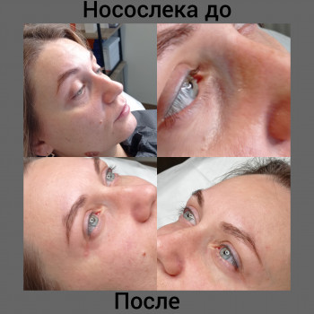 Коррекция носослезной борозды