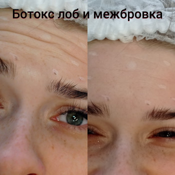 Ботокс лоб+ межбровка