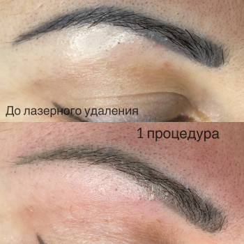 Видалення татуажу, фото - Майстер перманентного макіяжу Любовь Дектерева