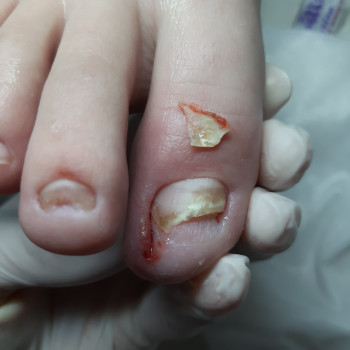 Ноготь врос ,кровь гной ,отёк,воспаление.
Клиенту помогла ,