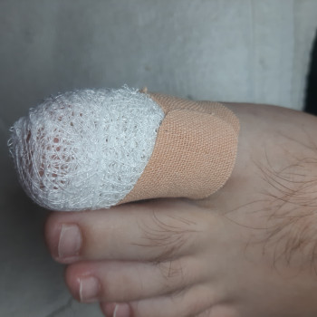 Перевязка после того как обработали вросший ноготь.