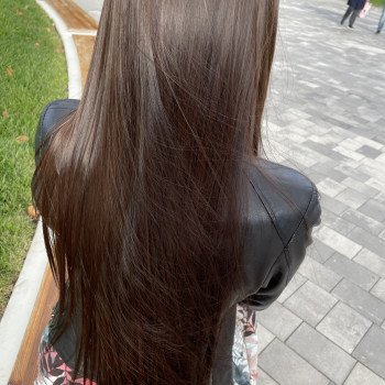 Біксипластія, фото - трихолог Оксана С