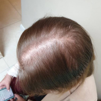 Трихопігментація шкіри голови - фото ДО процедури. Маскуванн