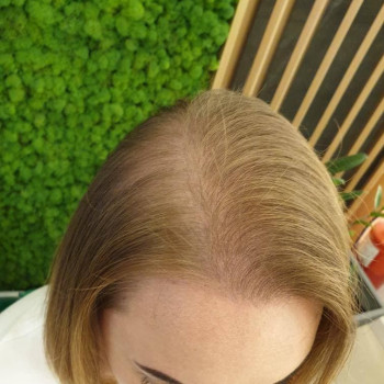 Трихопігментація шкіри голови - фото ПІСЛЯ процедури - візу