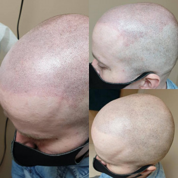 Трихопігментація шкіри голови у мужчини - імітація волосяних