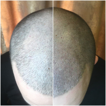 Трихопігментація голови мужчин фото до/після