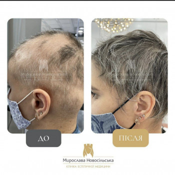 Лікування облисіння у Клініці Мирослави Новосільської