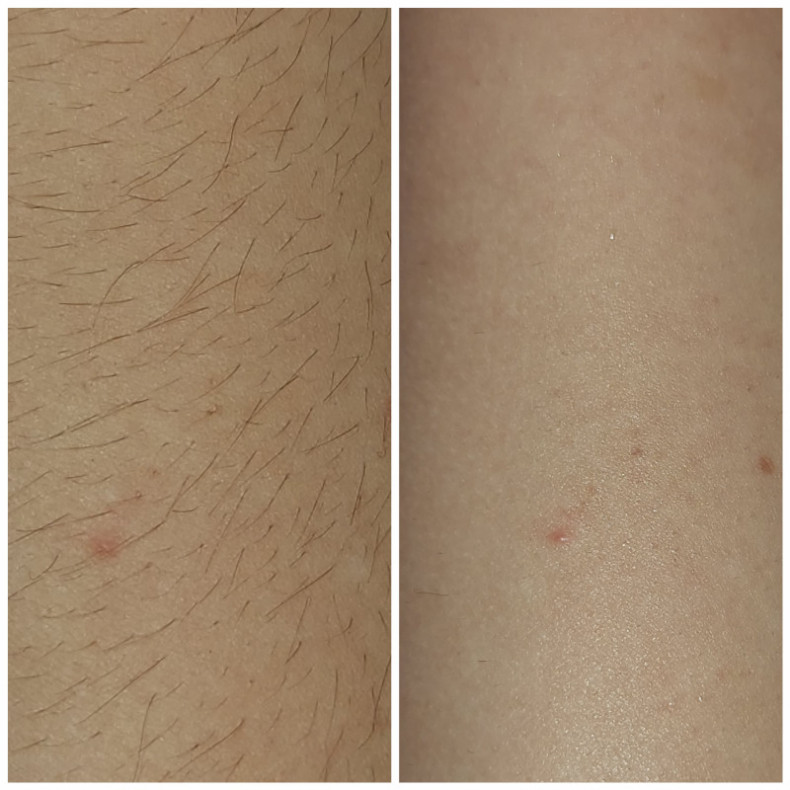 Воскова депіляція., фото - Косметолог Марія Борисівна Святошенко