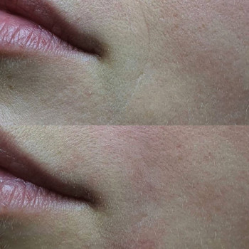 Ботулінотерапія у Львові