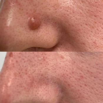 Видалення бородавок та доброякісних новоутворень лазером.