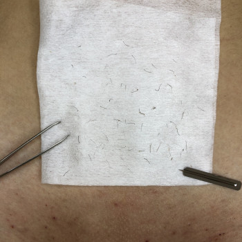 Для процедури з лікування врослого волосся використовую одно