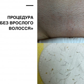 Без лікування врослого волосся, Ваша шкіра ніколи не буде ви