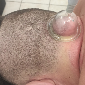 Вакуумний масаж потилиці і шиї