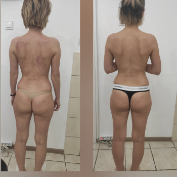 Після 5 сеансів масажу Starvac, проміжний результат. 
Ще