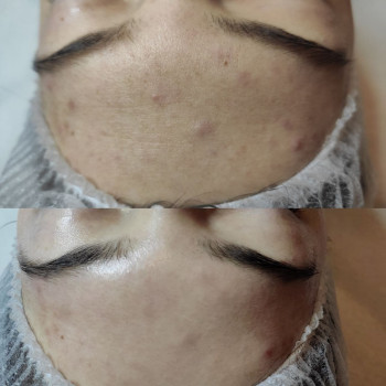 Комбінована чистка обличчя
                    Косметолог Людмила Киев