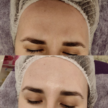 Чистка + карбоксітерапія ACNE -PRO
                    Косметолог Людмила Киев