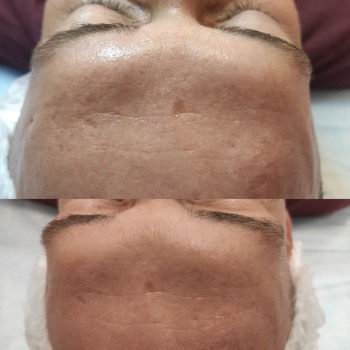 Чистка + карбоксітерапія ACNE -PRO
                    Косметолог Людмила Киев