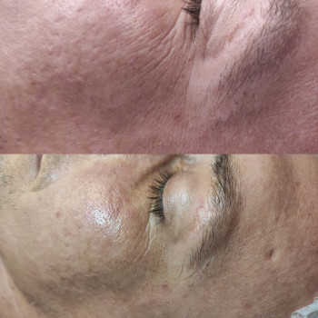 Чистка + карбоксітерапія ACNE -PRO
                    Косметолог Людмила Киев