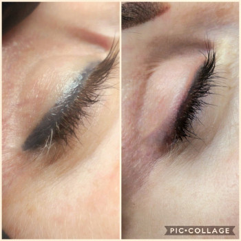 Удаление лазером и ремувером