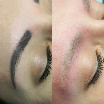 Лазерное удаление бровей