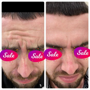 Коррекция межбровной области