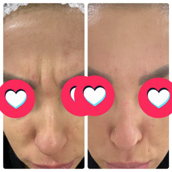 Коррекцию межбровной области