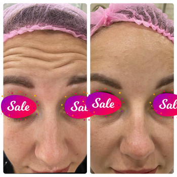 Применение ботулотоксина в верхней трети лица