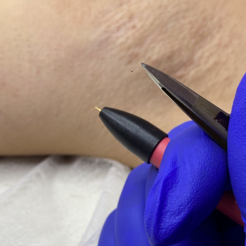 Процес видалення волосся назавжди