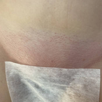 Гладенька шкіра зразу після процедури, почервоніння проходит