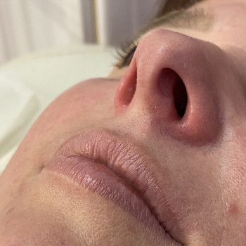 Видалення волосся у ніздрях для естетичного вигляду