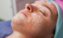 Карбоксітерапія Medicare ACNE - PRO Косметолог Людмила Київ