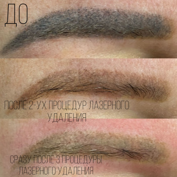 Лазерное Удаление некачественного татуажа
                    Салон краси Studio Shishenko Дніпро
