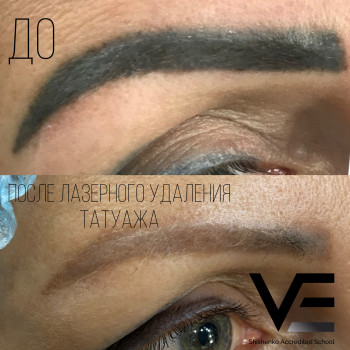 Лазерное Удаление некачественного татуажа
                    Салон краси Studio Shishenko Дніпро